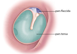 Pars tensa and pars flaccida of the tympanic membrane. The pars tensa has three layers: lateral stratified squamous epithelium, central fibrous layer, and medial low cuboidal mucosal epithelium. The pars flaccida is deficient in its fibrous layer.