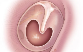 Typical “kidney bean shaped” central tympanic membrane perforation.
