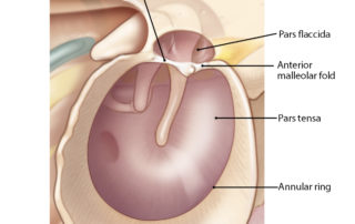 Relationship of the tympanic membrane to the tympanic ring and ossicles.