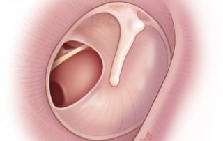 Posterior marginal tympanic membrane perforation. The location over the round window leads to a greater conductive hearing loss due to phase cancellation.