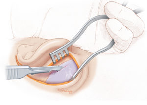 Harvesting fascia for tympanoplasty. An incision is made above the linea temporalis leaving about 1 cm of intact fascia to facilitate closure of the postauricular incision.