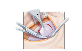 The superior incision is made easier by curved scissors such as Fomon upper lateral cartilage scissors.