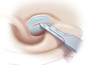 In cartilage and/or perichondrium harvesting, the incision is hidden on the canal side of the tragus.