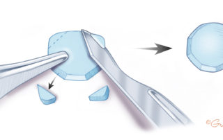 Cartilage disc is shaped for use in tympanic membrane reconstruction, to overlie an ossicular prosthesis, and/or to repair an epitympanic defect. Note the beveling of the cartilage on the surface facing the tympanic membrane.