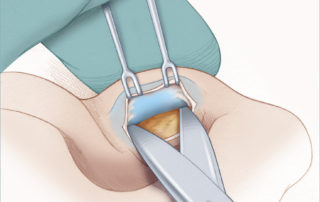 Dissection is carried down the posterior surface of the tragus.