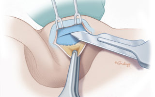 Incision is made through the ipsilateral perichondrium and partial thickness into the cartilage.