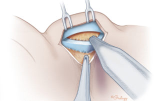 Scissors complete the cartilage incision and establish the plane on the anterior surface.