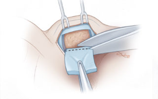 Pulling laterally with Brown-Adson forceps while making the medial cut. Handling cartilage with standard toothed Adson forceps should be avoided, as they tend to lacerate the cartilage.