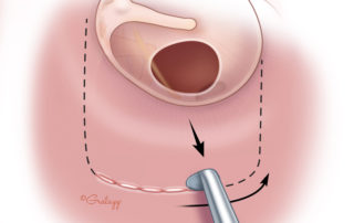 Crushing the tissue along the incision line reduces bleeding and helps obtain a smoothly cut incision.