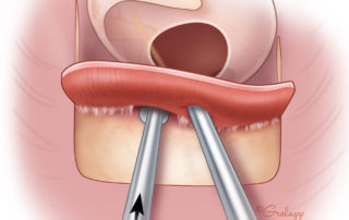 Elevation of the tympanomeatal flap toward the annulus.