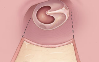 Postauricular approach to tympanoplasty after elevation of a posterior ear canal flap (Koerner’s flap).