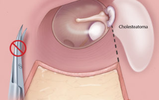 In cholesteatoma, only a superior incision is utilized in tympanoplasty which outlines an inferiorly based meatal skin flap.