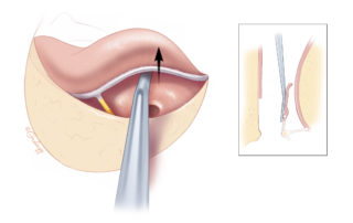 It is important to have the middle ear exposure remain adequately open throughout the surgery. Using the back of the annulus elevator, the flap can be pushed against the anterior canal wall where surface tension will adhere to it.