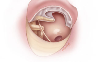 Tympanomeatal flap folded forward revealing the undersurface of the remnant tympanic membrane.
