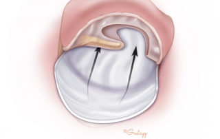 The fascia graft is positioned under the tympanic membrane remnant.