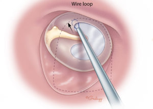 Adjusting the graft into position using a wire loop. If suction is needed, use a small diameter suction (e.g., no. 3 Fr or no. 20 needle) and keep an instrument (e.g., annulus elevator or wire loop) between the suction and graft. When using a suction near a graft in position, it is prudent to request your assistant to be ready to plug the suction so that it can be disengaged without disturbing the graft.