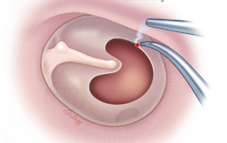 Rimming of the tympanic membrane perforation with a laser.