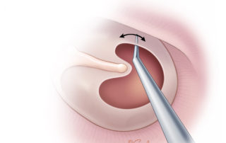 Roughing up the mucosal surface on the medial aspect of the tympanic membrane enhances adhesion of the graft and opens vessels for neovascularization.
