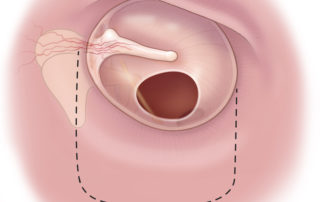 The tympanomeatal flap used in tympanoplasty and ossiculoplasty is longer than that used in stapes surgery.