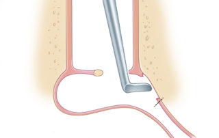 Disrupting protympanic mucosa to facilitate adhesion and vascular ingrowth.