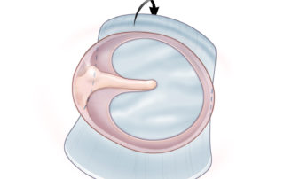 Repair of anterior tympanic membrane perforation with graft extending into the protympanum.