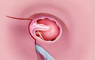 In the lateral graft technique, superior incisions describe a vascular strip flap to be elevated laterally.