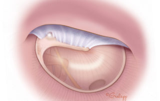 Anterior blunting is a complication of lateral graft technique which results from insufficient contouring of the anterior canal (see section 3.8 Anterior Canaloplasty in Chapter 3).