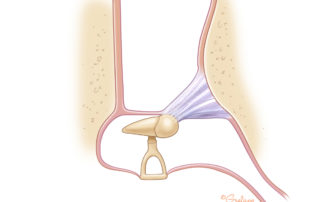 Anterior blunting may result when anterior canal bulge is not corrected. This complication is more common with lateral graft technique.