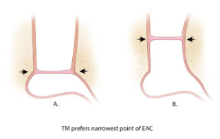 The healing tympanic membrane may favor the narrowest portion of the ear canal. A prominent temporomandibular joint bulge should be corrected by anterior canaloplasty so that the narrowest point is at the tympanic annulus.