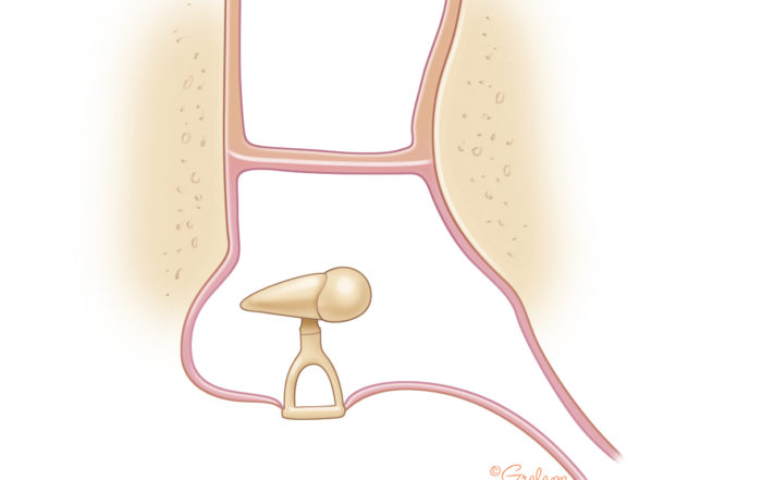 Lateral Graft Tympanoplasty Oto Surgery Atlas