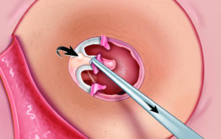 Removing squamous layer for the tympanic membrane remnants leaving the fibrous and mucosal layers in place. It is important that all epithelial elements are removed to prevent epithelial pearls from developing in the future. The skin of the canal and TM remnant can be removed separately, as shown here, or in continuity.