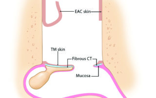 Schematic illustrating the initial stages of the lateral graft technique. EAC,- external auditory canal; TM, tympanic membrane; CT, connective tissue.
