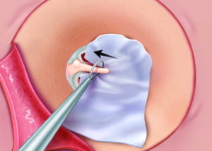 Placement of the fascia graft over the tympanic membrane remnant. A wire loop may be used to position the graft beneath the umbo.