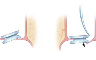 Holding the posterior wing of the butterfly cartilage graft with alligator forceps, the graft is positioned with the perforation (left). Using a curved needle, the graft is rotated into position.