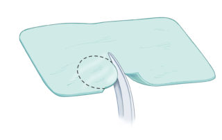 Cut an estimated size template using the cover of a suture pack or other convenient sterile material.