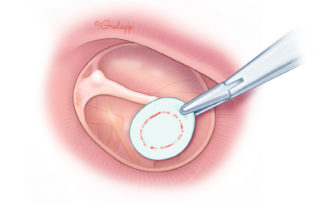 Place the template on the tympanic membrane in order to stain it with some blood from the edges. This enables more accurate shaping, especially for other than round-shape perforations.