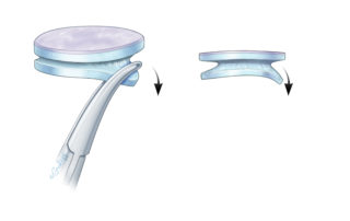 Use a fine-tipped forceps to gently crush the medial wing edges, separating them to create space for the TM perforation edges. The anterior side of the medial wing is bent more prominently to facilitate easier insertion.