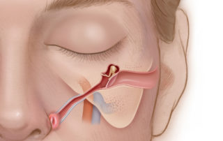 Frontal view of Eustachian tube. Eustachian tube is a curved structure that is usually at a 30-degree angle from the middle ear cavity and curves anteriorly toward the nasopharynx.