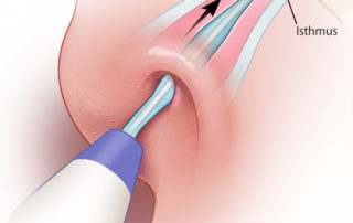 The deflated balloon is inserted into the opening of the Eustachian tube in the nasopharynx. The balloon will slide in without significant resistance if in the native lumen.