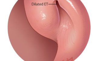 Balloon is removed. The Eustachian tube (ET) postdilation appears to be enlarged at the superior aspect of the opening.