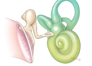 Normal ossicular chain (malleus–incus–stapes) showing the tympanic membrane and inner ear (cochlea and semicircular canals).