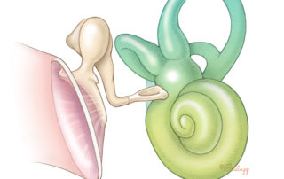 Normal ossicular chain (malleus–incus–stapes) showing the tympanic membrane and inner ear (cochlea and semicircular canals).