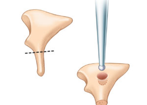 Shaping the incus body to serve as an autologous ossicular reconstruction. The long process is removed and a well for the capitulum is drilled in the incus body.