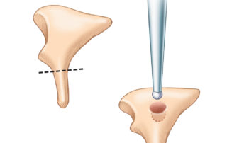 Shaping the incus body to serve as an autologous ossicular reconstruction. The long process is removed and a well for the capitulum is drilled in the incus body.