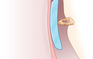 Ossiculoplasty using cartilage alone is sometimes possible following canal wall down mastoidectomy when the middle ear space is narrow. Laying the tympanic membrane directly on the capitulum has a substantial failure rate due to poor contact. A cartilage sheet resting on the capitulum enhances contact with the tympanic membrane.