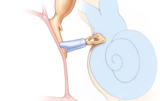 Ceramic crutch and cup-type prosthesis connecting the malleus long process (manubrium) with the capitulum of the stapes. Because the manubrium lies anterior to the stapes, and is often medialized due to retraction and scarring from infection, it is often challenging to achieve stability. Both crutch and cup often need to be modified with a drill to mortise into position.