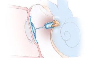 Titanium partial ossicular replacement prosthesis (PORP). To discourage extrusion, autologous cartilage is interposed between the prosthesis and tympanic membrane. Many surgeons use this form of reconstruction whenever the incus is deficient regardless of the status of the malleus.