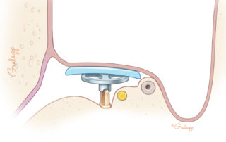 A Frisbee prosthesis is used in canal wall down settings when the middle ear is narrow. Cartilage alone may not develop a satisfactory connection with the capitulum of the stapes. This type of prosthesis widens the surface area of contact.
