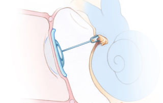 Use of a long titanium partial ossicular replacement prosthesis (PORP) onto an anterior crural remnant sufficient to serve as an anchor.