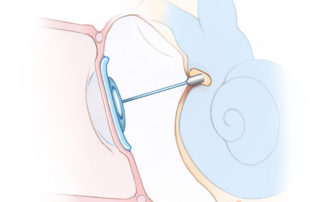 Total ossicular replacement prosthesis (TORP). To discourage extrusion, autologous cartilage is interposed between the prosthesis and the tympanic membrane.